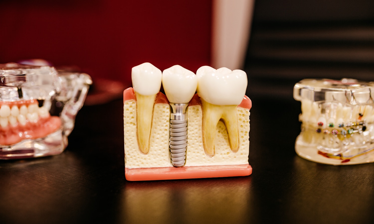 A dental model showing how an implant replaces a missing tooth